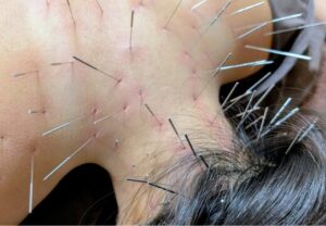 耳鳴り上尾埼玉鍼ルート治療自律神経