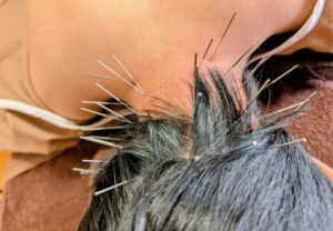 めまい不眠症睡眠障害鍼上尾ルート治療パニック障害