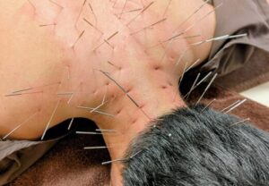 動悸息苦しさ過呼吸不眠症睡眠障害鍼上尾埼玉ルート治療自律神経