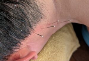 突発性難聴上尾鍼ルート治療自律神経埼玉