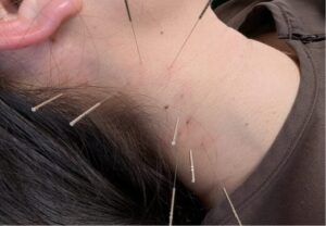 メニエール病上尾鍼ルート治療自律神経埼玉