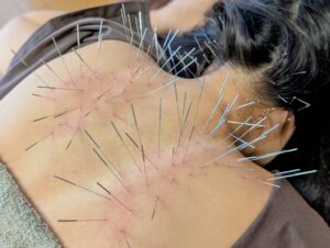 自律神経失調症上尾鍼ルート治療自律神経埼玉