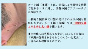 上尾鍼ルート治療自律神経埼玉